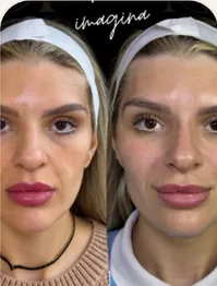 Antes e depois de harmonização facial