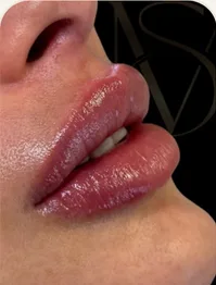 Resultado de preenchimento labial