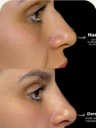 Antes e depois de rinomodelação